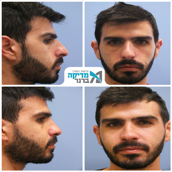 ניתוח פלסטי באף
